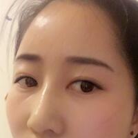 自體脂肪填充太陽(yáng)穴豐額頭親身經(jīng)歷，多過程恢復(fù)圖分享