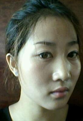 自體脂肪填充術(shù)前照片