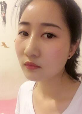 自體脂肪填充太陽穴+額頭一個(gè)半月