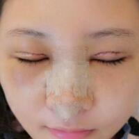 在昆明做了眼睛和鼻子整形，雖然花費(fèi)了16000元，但人美了就值！