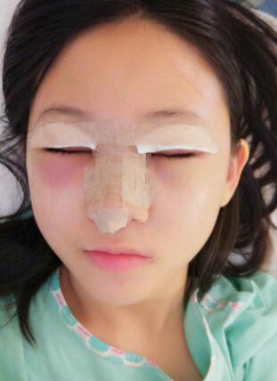割雙眼皮+隆鼻