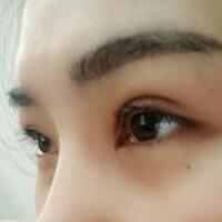 割雙眼皮手術(shù)價(jià)格3200元，單眼皮變雙眼皮，去皮去脂，美美的~