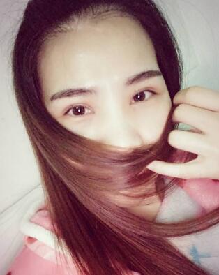 割雙眼皮第五天