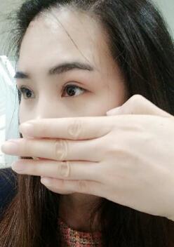 割雙眼皮半個月