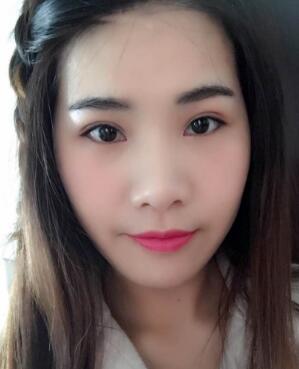 割雙眼皮兩個月,雙眼皮已經(jīng)完全穩(wěn)定