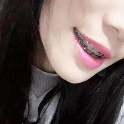 牙齒矯正的真實過程，現(xiàn)在我終于可以露出牙齒放聲大笑了