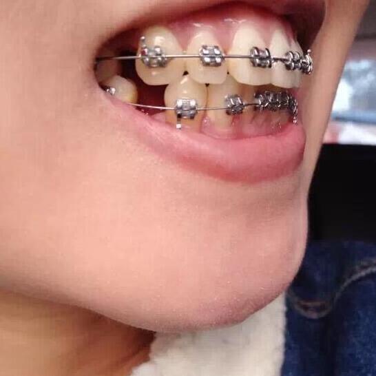 牙齒矯正前后對比照真實過程分享終于不是齙牙妹了哦