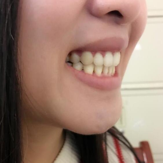 牙齒矯正前后對比照真實過程分享終于不是齙牙妹了哦