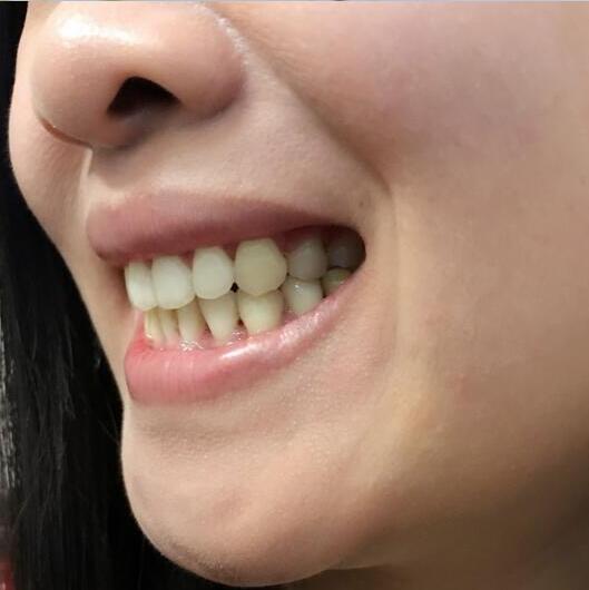 牙齒矯正前后對比照真實過程分享終于不是齙牙妹了哦