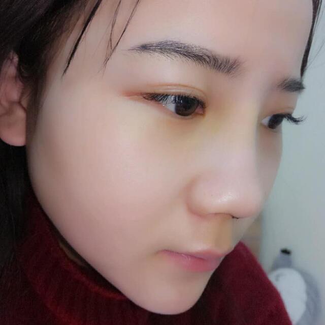 隆鼻整形前后恢復過程隆鼻梁+墊鼻尖整形果很好哦