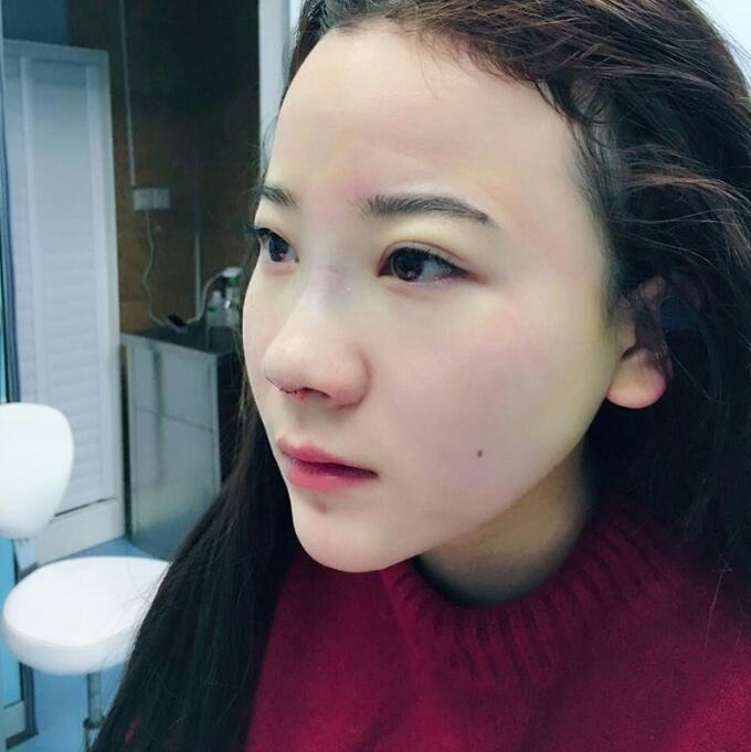 隆鼻整形前后恢復過程隆鼻梁+墊鼻尖整形果很好哦