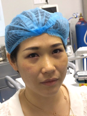 激光祛眼袋2個月，不用手術(shù)就可以變得很年輕哦！