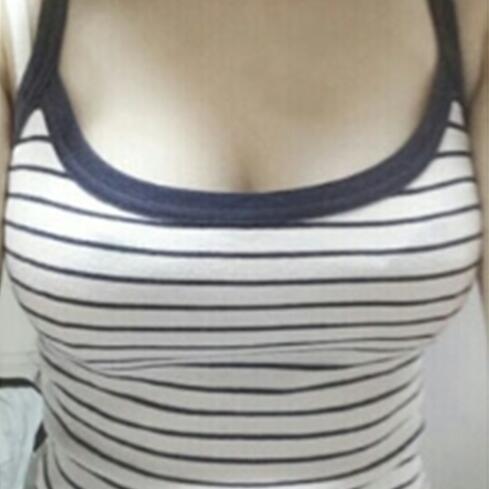 自體脂肪隆胸手術(shù)價(jià)格21800做的，恢復(fù)過程圖分享