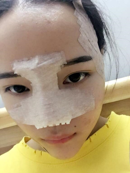 我的硅膠隆鼻+自體脂肪豐下巴+自體脂肪豐太陽穴恢復(fù)果案例日記