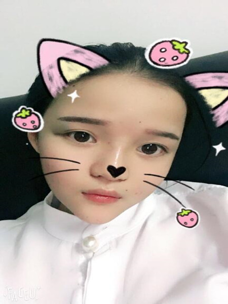 我的硅膠隆鼻+自體脂肪豐下巴+自體脂肪豐太陽穴恢復(fù)果案例日記