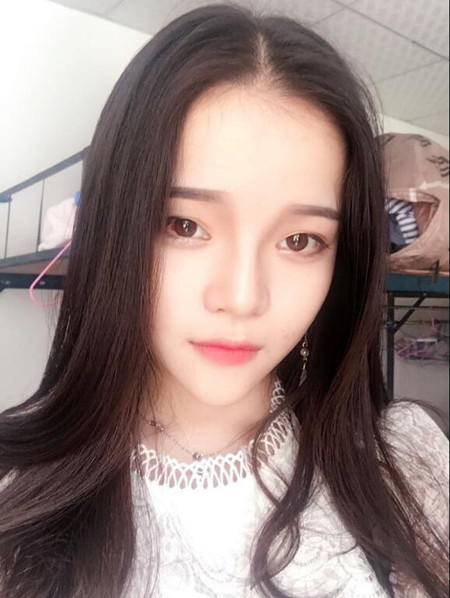 我的硅膠隆鼻+自體脂肪豐下巴+自體脂肪豐太陽穴恢復(fù)果案例日記