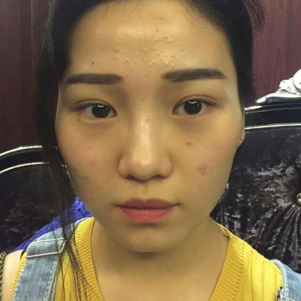 玻尿酸墊下巴手術(shù)恢復(fù)全過(guò)程圖片分享