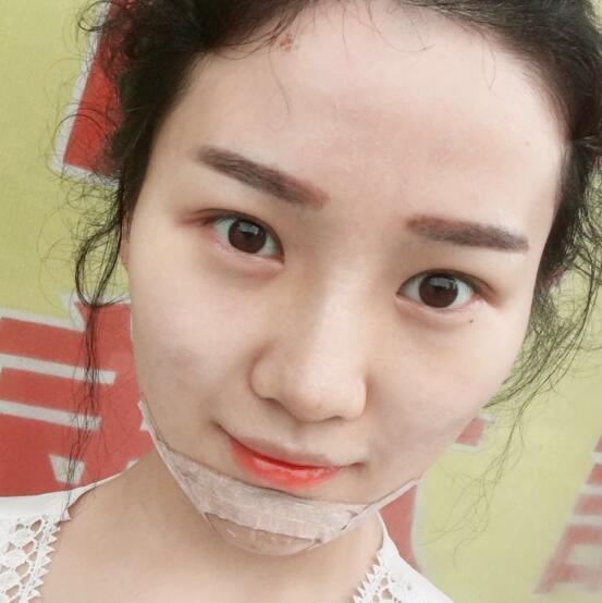 玻尿酸墊下巴手術(shù)恢復(fù)全過(guò)程圖片分享