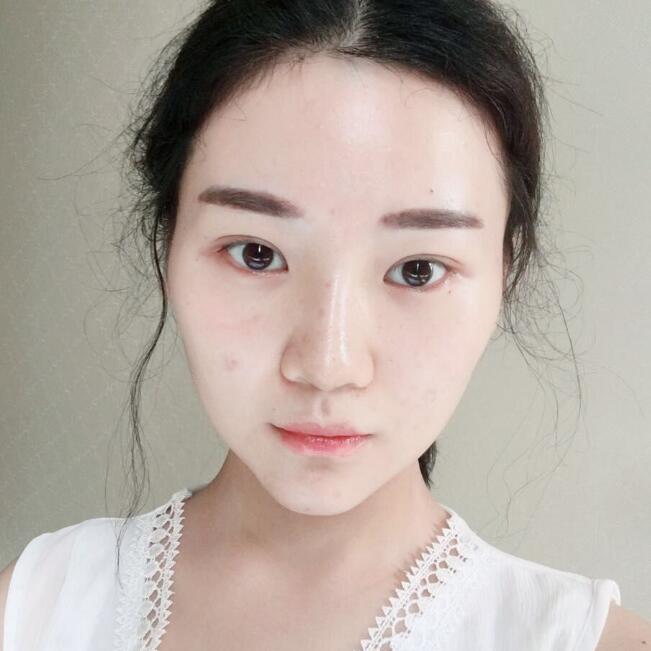 玻尿酸墊下巴手術(shù)恢復(fù)全過(guò)程圖片分享