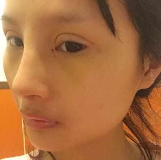 自體脂肪隆鼻+割雙眼皮的恢復(fù)過(guò)程讓我找到了自信