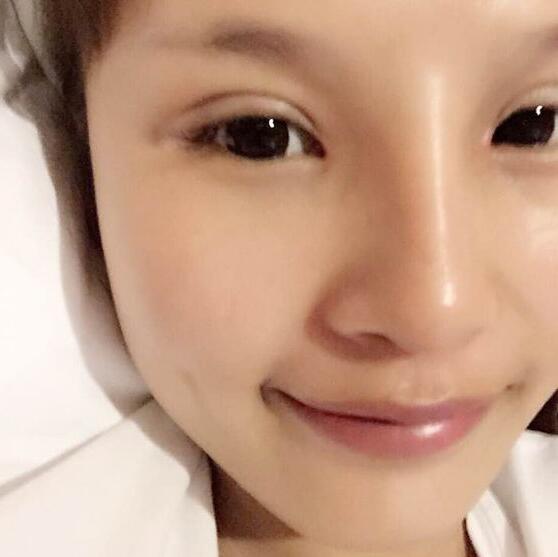 自體脂肪隆鼻+割雙眼皮的恢復(fù)過(guò)程讓我找到了自信