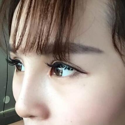 自體脂肪隆鼻+割雙眼皮的恢復(fù)過(guò)程讓我找到了自信