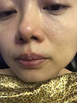 做了高強(qiáng)度聚焦超聲，果還不錯(cuò)，想把經(jīng)歷分享給大家