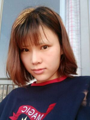 隆鼻整形真實(shí)恢復(fù)期圖片，大鼻子終于變秀氣了