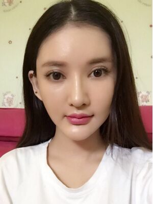 面部埋埋蛋白線.提升術(shù)后照片，皮膚緊致不少了