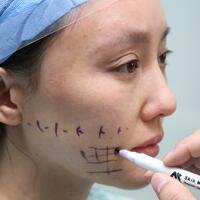 蛋白線面部埋埋蛋白線.提升手術(shù)價(jià)格15000元，果不錯分享給大家