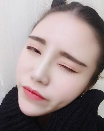 耳軟骨墊鼻尖一個(gè)月圖