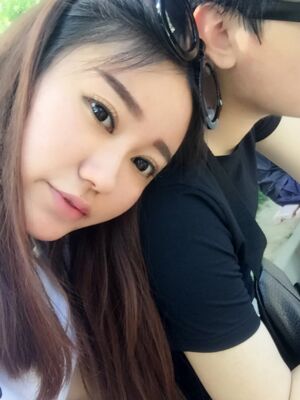 雙眼皮失敗修復(fù)手術(shù)恢復(fù)前后對(duì)比圖