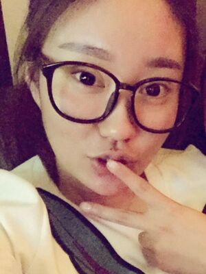 雙眼皮失敗修復(fù)手術(shù)恢復(fù)前后對(duì)比圖