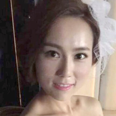 上海九院戴傳昌玻尿酸注射隆鼻和墊下巴案例