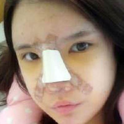 鄭大一附院劉林嶓膨體隆鼻+自體脂肪面部填充案例