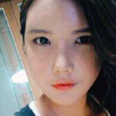 鄭大一附院劉林嶓膨體隆鼻+自體脂肪面部填充案例