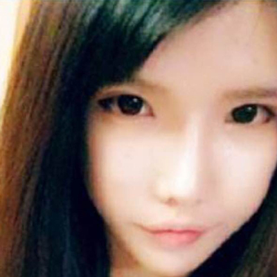 鄭大一附院劉林嶓膨體隆鼻+自體脂肪面部填充案例