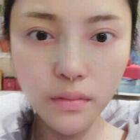 假體隆鼻15天后恢復(fù)圖，隆鼻果自然