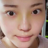 假體隆鼻15天后恢復(fù)圖，隆鼻果自然