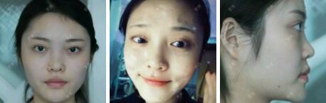 假體隆鼻15天后恢復(fù)圖，隆鼻果自然