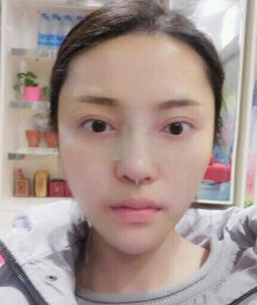 假體隆鼻15天后恢復(fù)圖，隆鼻果自然