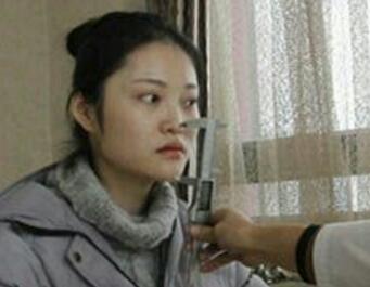 假體隆鼻15天后恢復(fù)圖，隆鼻果自然