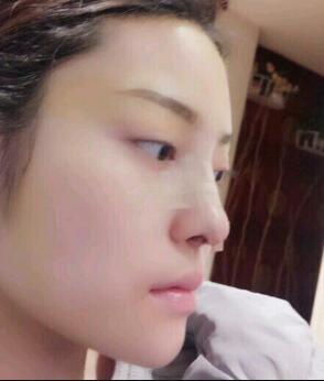 假體隆鼻15天后恢復(fù)圖，隆鼻果自然