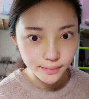 假體隆鼻15天后恢復(fù)圖，隆鼻果自然