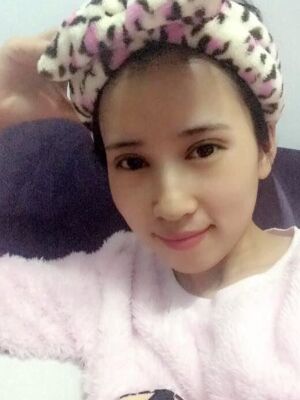 切開雙眼皮恢復(fù)過程，手術(shù)很成功哦