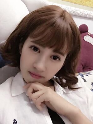 切開雙眼皮恢復(fù)過程，手術(shù)很成功哦