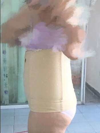 腰腹吸脂整形花了我兩萬多的錢  果真的挺不錯的