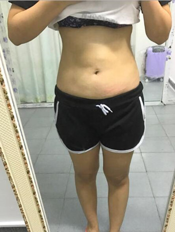 腰腹吸脂整形花了我兩萬多的錢  果真的挺不錯的