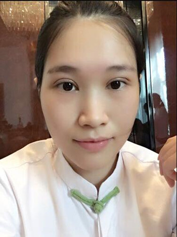 做全切雙眼皮花了8000多 整體恢復(fù)果真的很棒