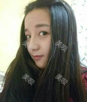 韓式隆鼻整形真實(shí)恢復(fù)期圖片，自然不夸張